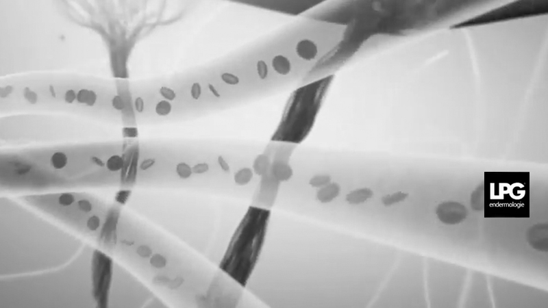 Vidéo clarifier teint - LPG endermologie