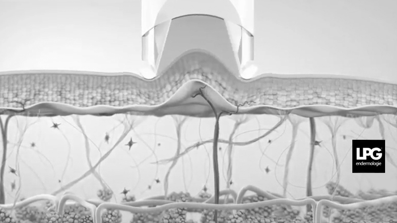 Vidéo menton - LPG endermologie