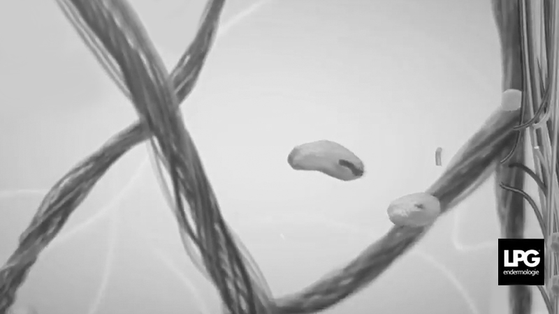Raffermir la peau - LPG endermologie