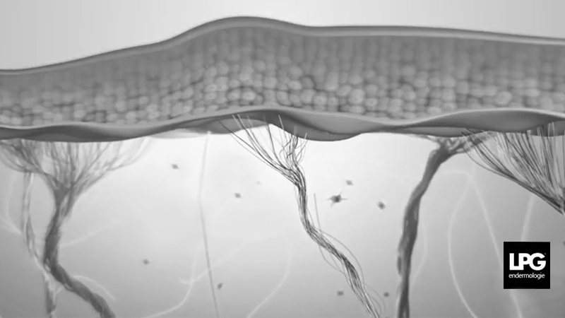 Vidéo rides - LPG endermologie